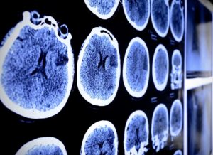 brain injury lawyer Sugar Land, TX